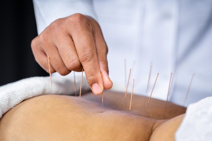 Acupuncture for pain management