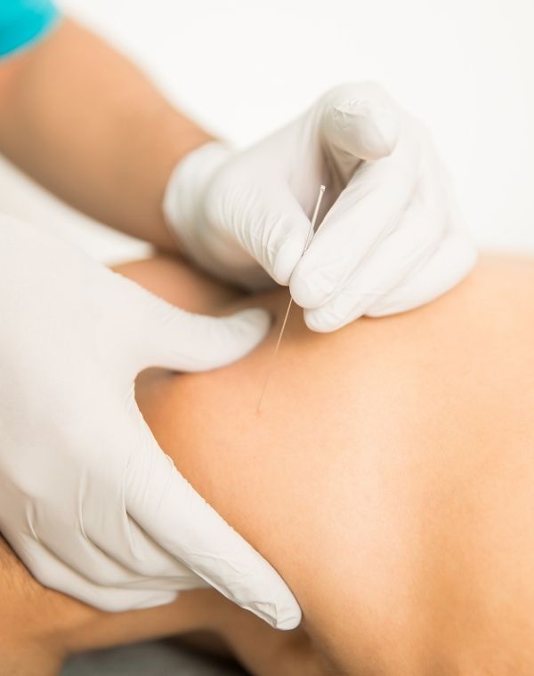 Dry Needling
